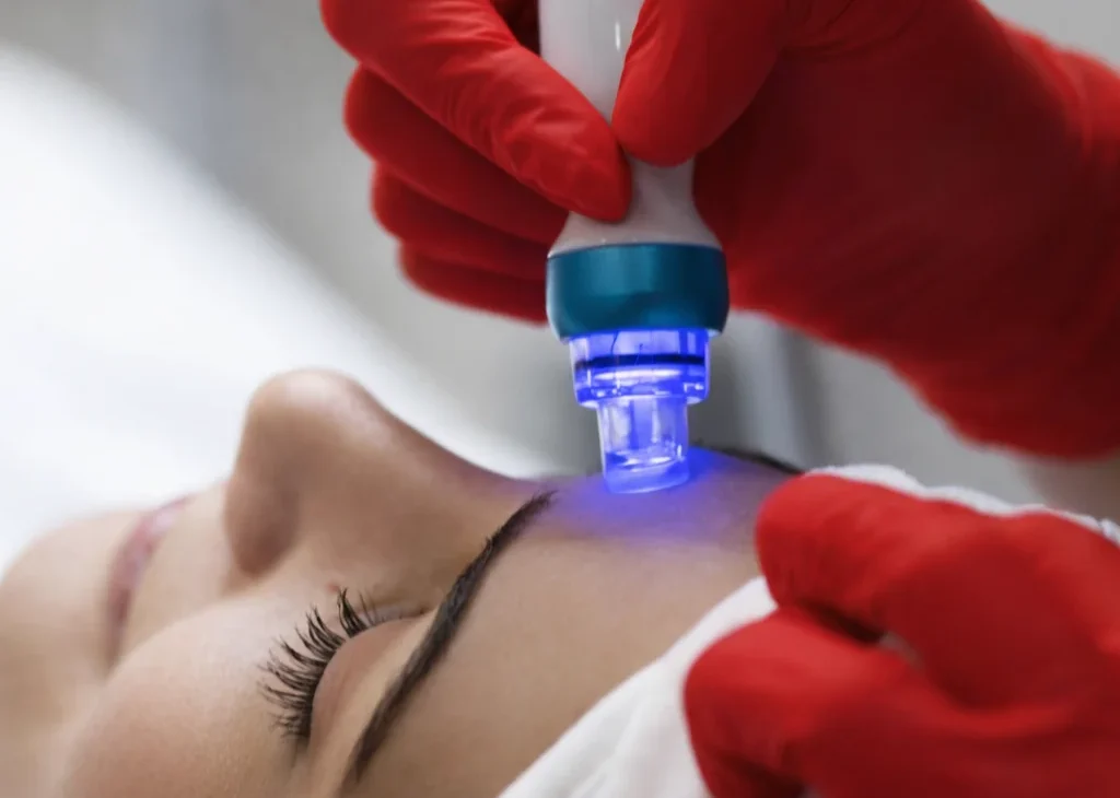 Home lijevo precica slika 1 copy Microneedling