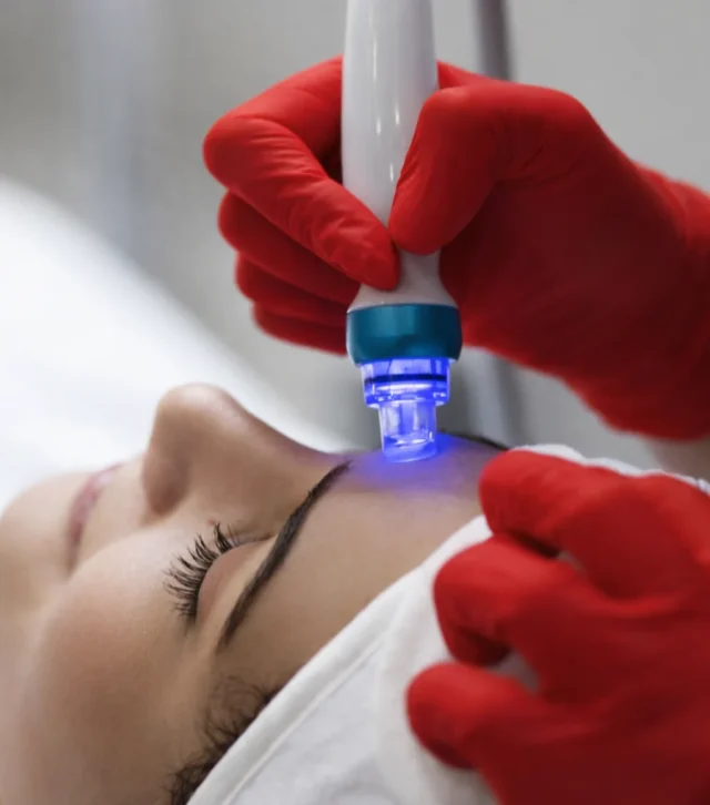 Microneedling